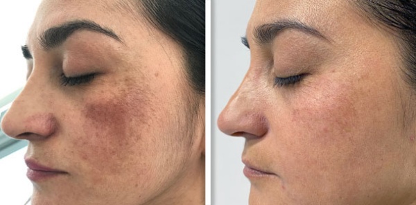 Melasma