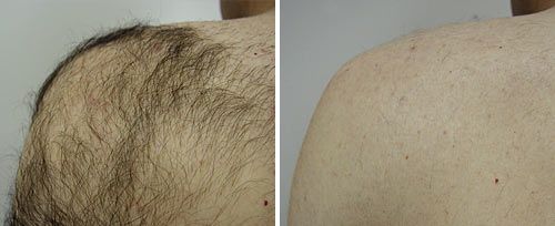 Permanent Hair Reduction